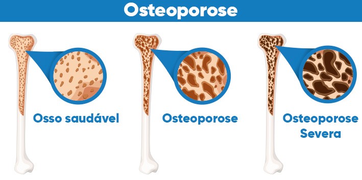 Osteoporose o que e densidade do osso Osteoporose o que e densidade do osso
